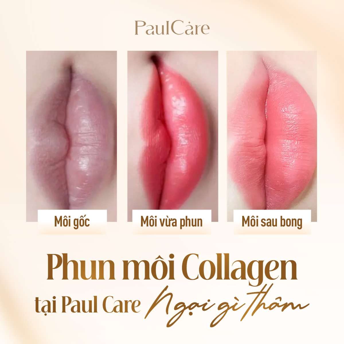 Hinh_anh_sau_khi_phun_moi_collagen_PaulCare